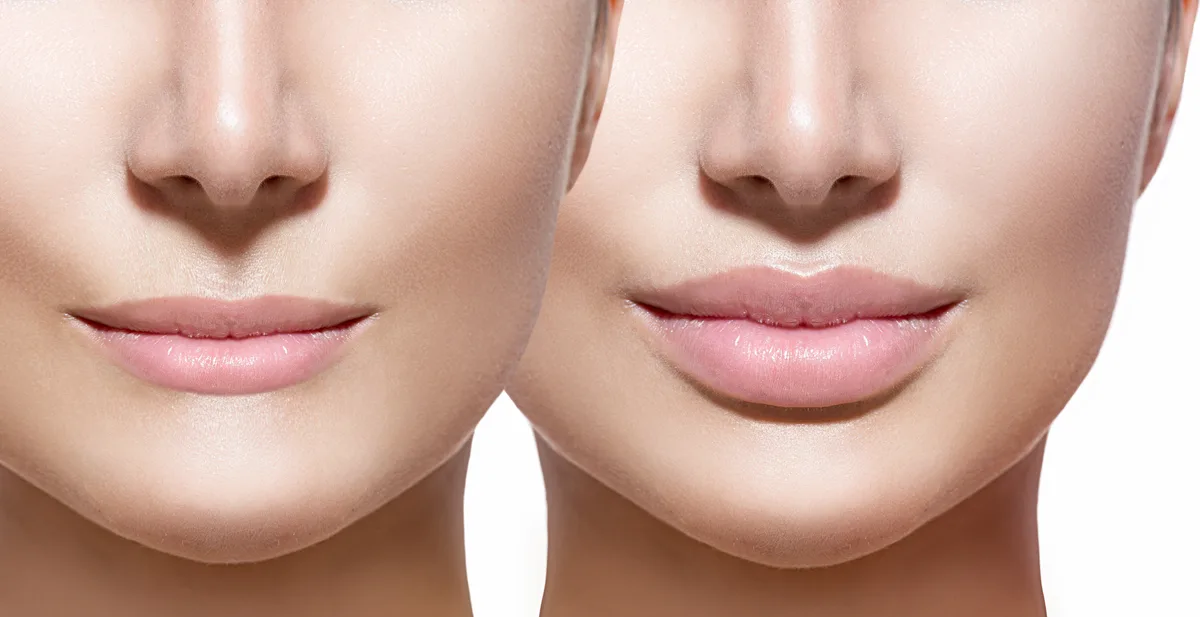 Lip filler treatment at Dermis